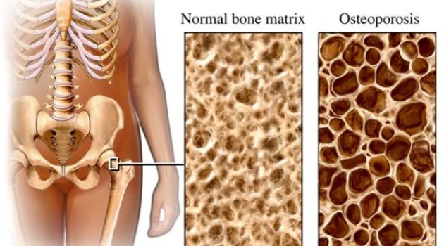 Osteoporosis, tratamiento y recomendaciones prácticas para prevenirla