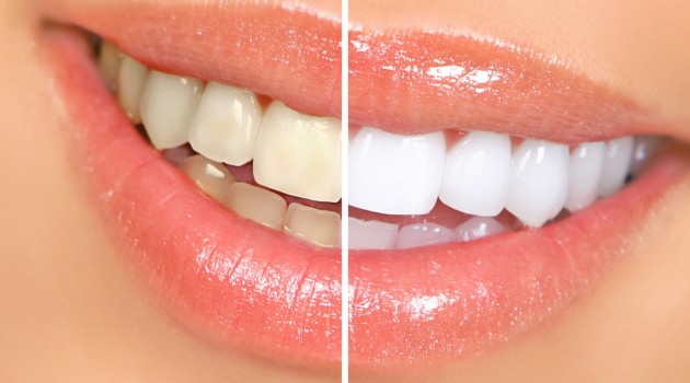 Mitos Y Realidades Sobre El Blanqueamiento Dental